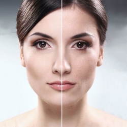 Мезотерапия